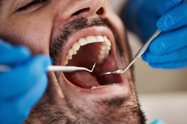 Best Emergency Wisdom Teeth Removal in Benton Harbor, MI